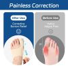 Bunion Corrector for Women & Men, Lightweight Toe Separator Splint, Wear in Shoes, Relieves Hallux Valgus Pain, Adjustable Toe Straightener Brace, Me